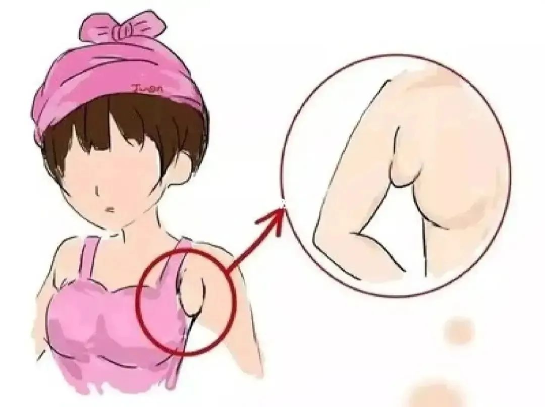 怎样有效消除产后副乳？